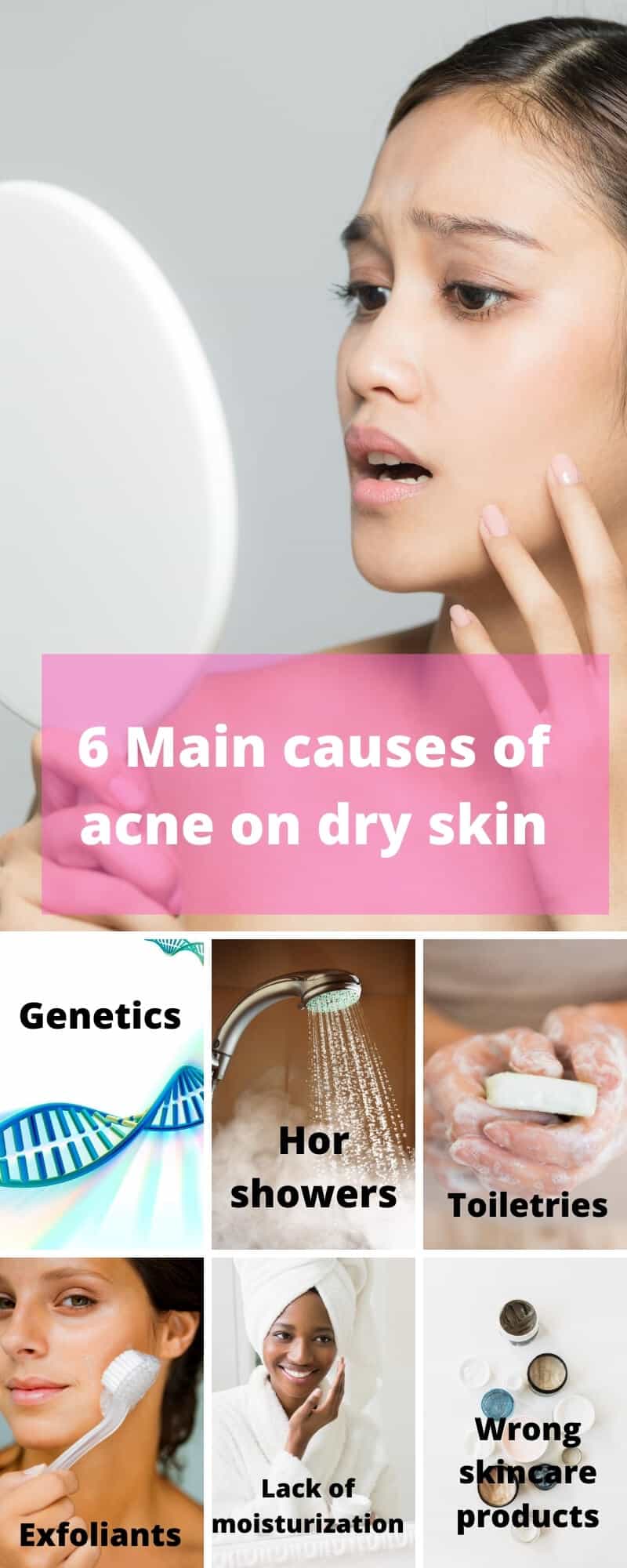 infographic of how dry skin produces acne