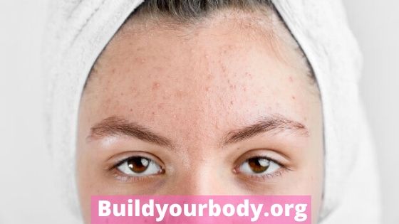 acne on dry skin