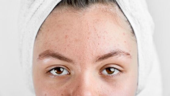 How acne is caused on dry skin