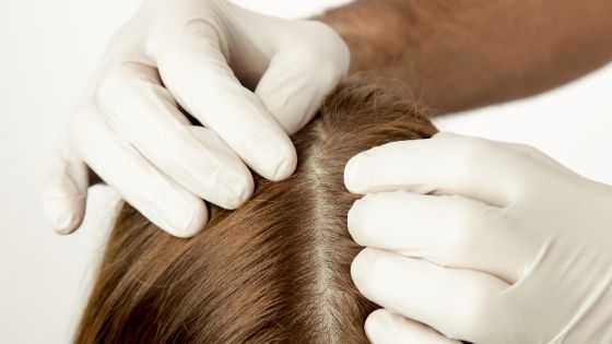 what is the reason for oily scalp?