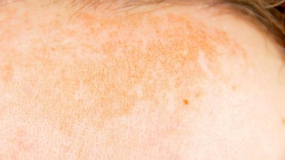 What triggers atopic dermatitis?