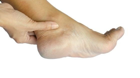 What causes cracked heels?