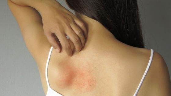 Can anxiety cause rashes?