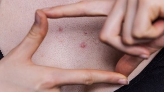 chest pimples causes