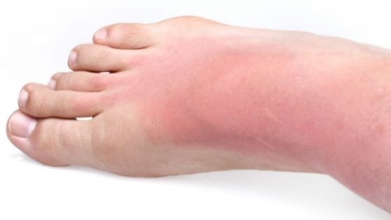 sunburn foot