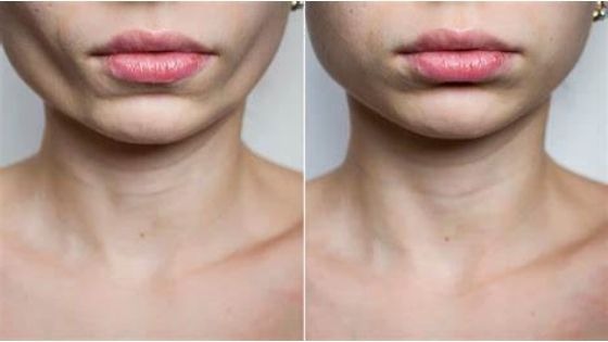 buccal fat removal, before and after