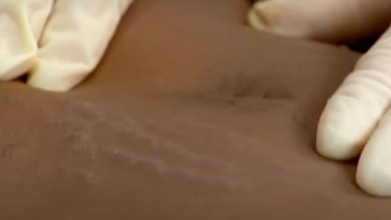 Are stretch marks common? skin with stretch marks